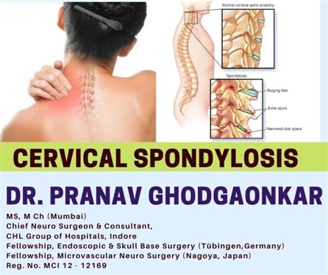 cervical spondylosis treatment doctors